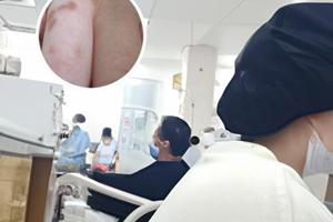 丙酸氟替卡松乳膏私处可以用吗
